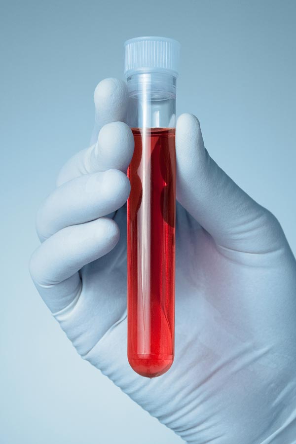 Close up of a gloved hand holding a vial of red liquid, representing Don D. Fisher, D.O. at The BEST Program's comprehensive autoimmune disorder treatment in Fort Lauderdale.