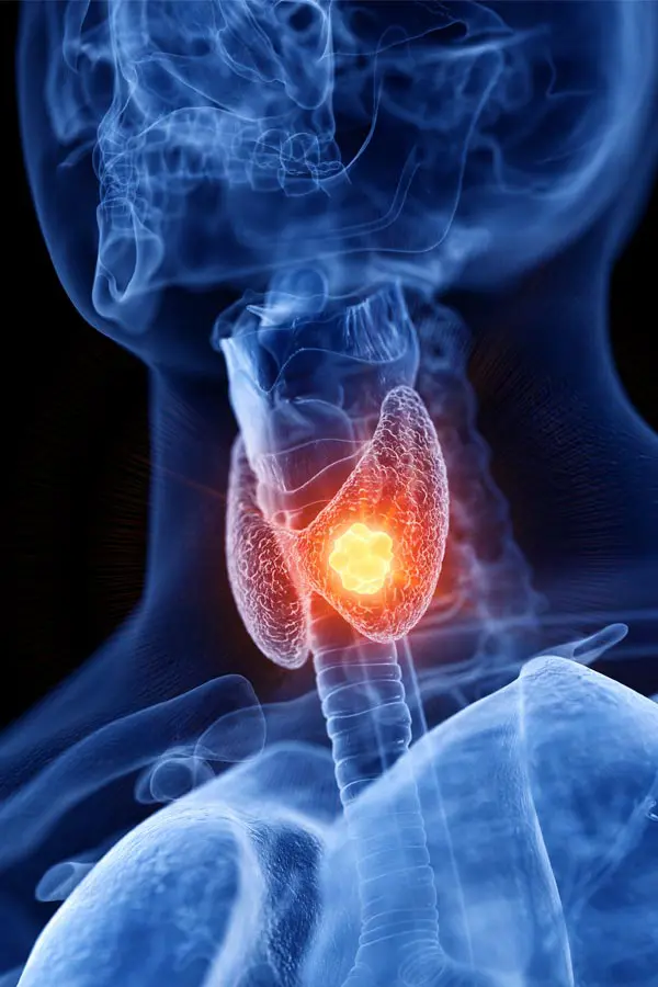 A 3D illustration of an x-ray of a human neck, highlighting the thyroid. Get help with thyroid imbalance from Don D. Fisher, D.O. at The BEST Program in Fort Lauderdale.